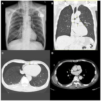 Case report: A rare complication after the implantation of a cardiac implantable electronic device: Contralateral pneumothorax with pneumopericardium and pneumomediastinum